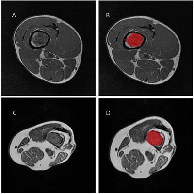 Development and validation of a MRI-based combined radiomics nomogram for differentiation in chondrosarcoma